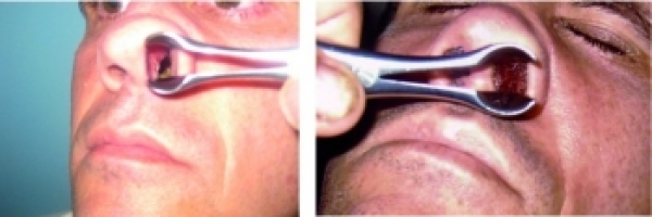 Septum perforation