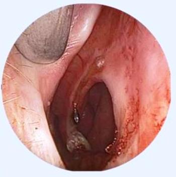 Septum perforasyonu